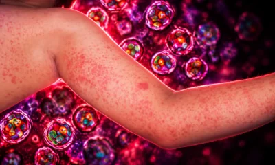 Pennsylvania sixth measles death Franklin County unvaccinated woman